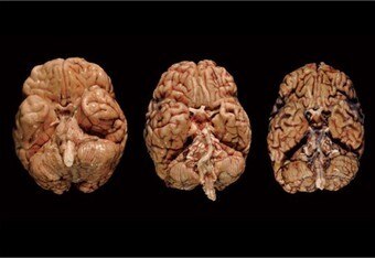 3brainsconcussion_crop_340x234
