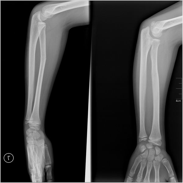 Nate Burleson's Injury: Best-Case, Worst-Case Scenarios for His Forearm