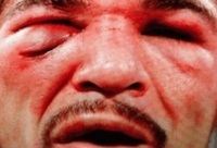 15 Brutal Post-Fight Faces 