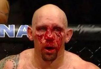 Broken Nose Ufc