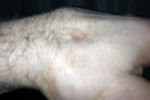Vitor-broken-hand_crop_150x100