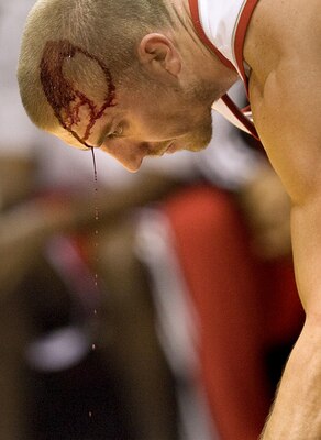 Blake-bleeding_display_image