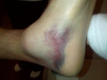 Favre-ankle-injury_display_image