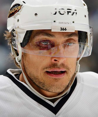 Hockey Eye Injury