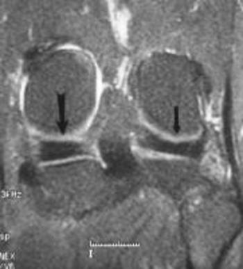 Medial and lateral meniscus (smaller arrow)
