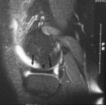 What Causes The Pain In A Meniscus Tear