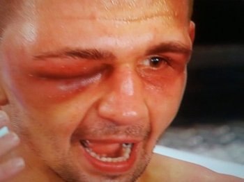 Wolak_swollen_eye_medium_display_image