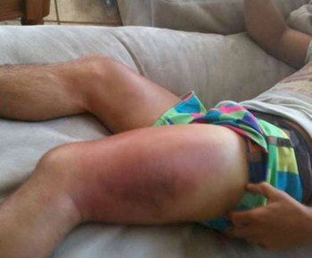 Faber's Leg After His WEC 48 Fight With Jose Aldo