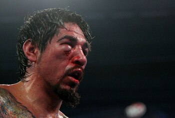 Antonio Margarito after getting his eye socket broken against Pacquiao.
