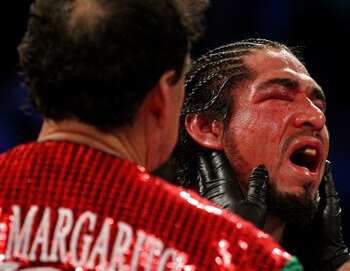 Antonio Margarito after his loss to Miguel Cotto
