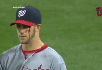 Bryce Harper receives 10 stitches above left eye after slamming