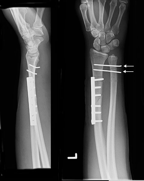 Nate Burleson's Injury: Best-Case, Worst-Case Scenarios for His Forearm ...