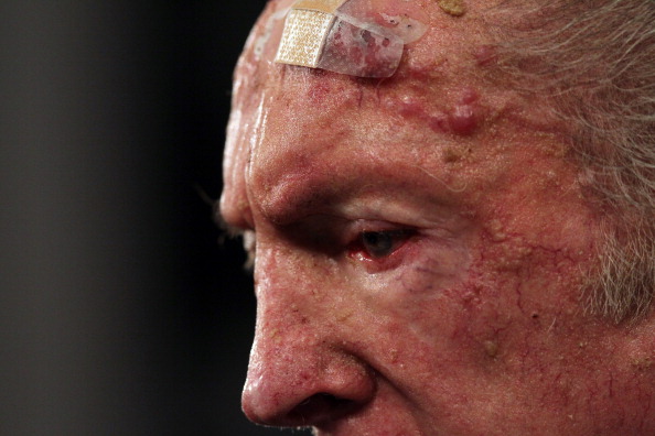 ALAMEDA, CA - JANUARY 18: A bandage is seen on the forehead of Oakland Raiders owner Al Davis as he speaks during a press conference on January 18, 2011 in Alameda, California. Hue Jackson was introduced as the new coach of the Oakland Raiders, replacing