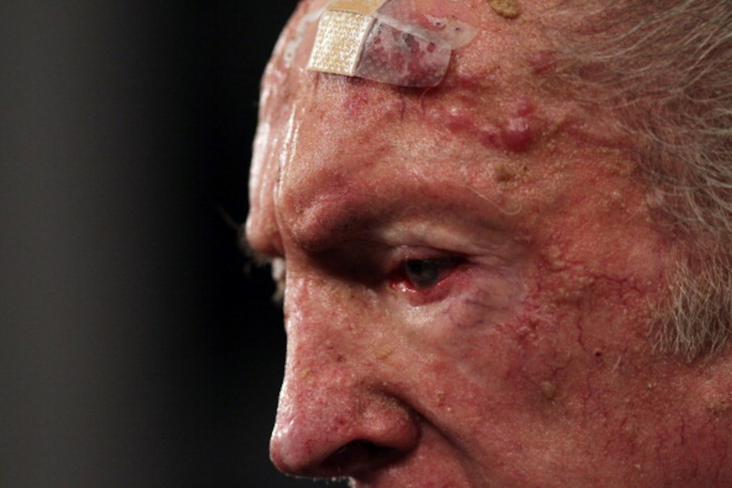 ALAMEDA, CA - JANUARY 18: A bandage is seen on the forehead of Oakland Raiders owner Al Davis as he speaks during a press conference on January 18, 2011 in Alameda, California. Hue Jackson was introduced as the new coach of the Oakland Raiders, replacing