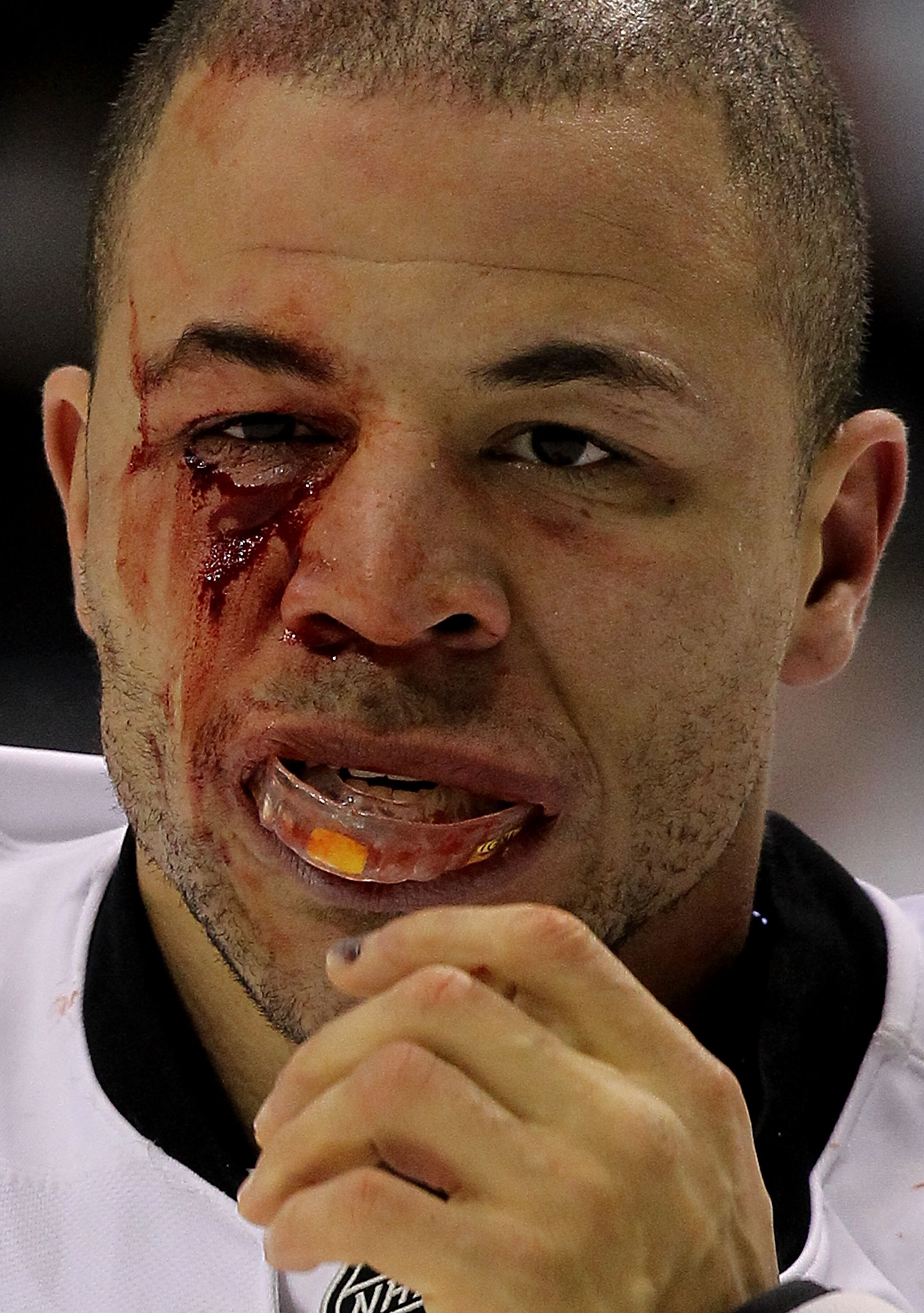 DALLAS, TX - DECEMBER 23: Right wing Jarome Iginla #12 of the Calgary Flames bleeds after a fight against Jamie Benn #14 of the Dallas Stars at American Airlines Center on December 23, 2010 in Dallas, Texas. (Photo by Ronald Martinez/Getty Images) DALLAS, TX - DECEMBER 23: Right wing Jarome Iginla #12 of the Calgary Flames bleeds after a fight against Jamie Benn #14 of the Dallas Stars at American Airlines Center on December 23, 2010 in Dallas, Texas. (Photo by Ronald Martinez/Getty Images)