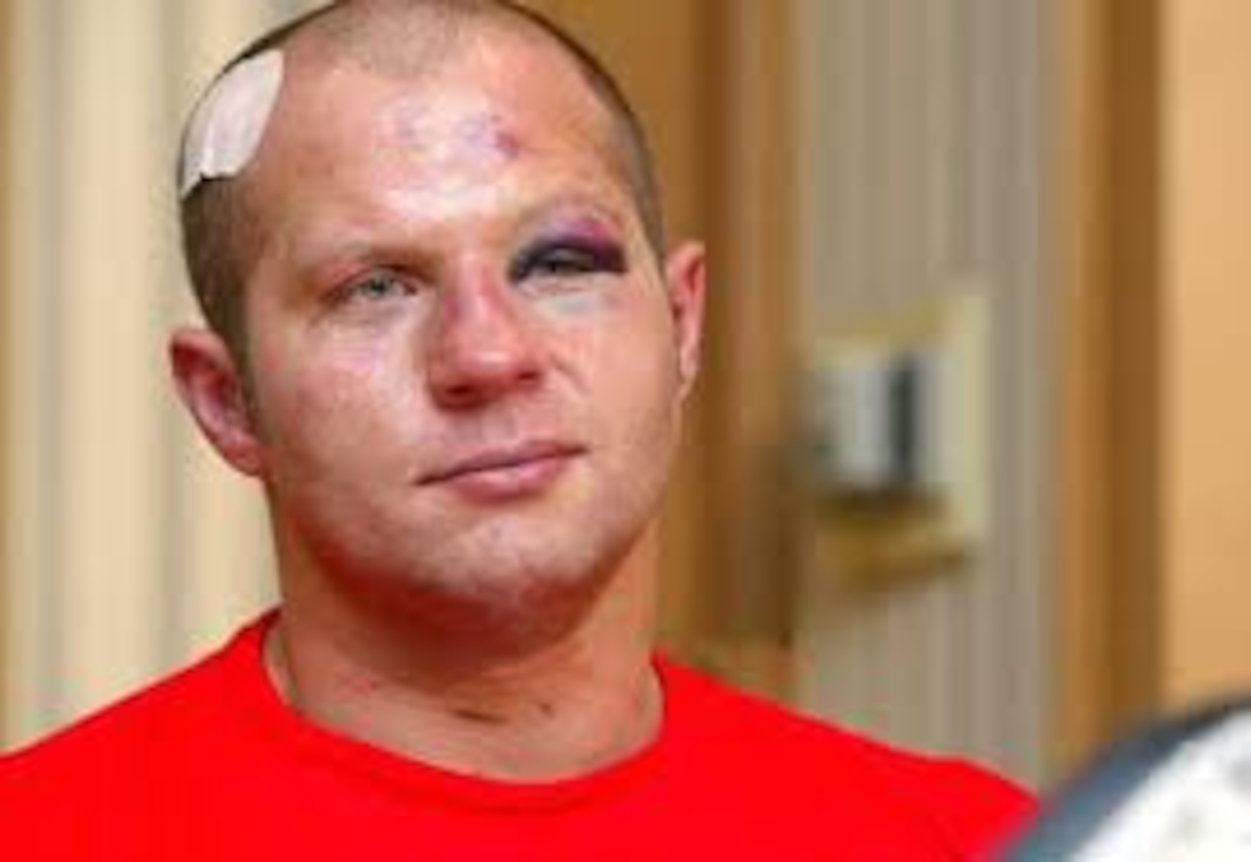 Fedor Emelianenko is not a machine; he is human and bruises!