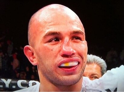 Vera's broken nose courtesy of Thiago Silva